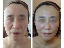 りた/たるみ改善＆ハリツヤ肌