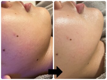 エフェクト 塚口店(effect)/Before after 10代/1回目