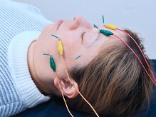 鍼灸整体院ヒビオル【曽根】/美容鍼＋電気♪