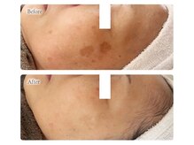 オービーエム 博多阪急店(O.B.M)/【40代シミケア症例】