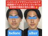 ハイパーナイフで小顔・艶肌リフトアップ!!