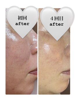 レンリー(Renry)の写真/【毛穴専門サロンで顔にある約20万個の毛穴を徹底ケア】レモンボトルでニキビ改善/透明肌にも◎