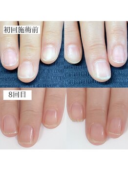 自爪矯正/地爪矯正/二枚爪/深爪