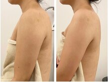 クレール アオヤマ(CLAIRE AOYAMA)/二の腕＆背中スリム＆姿勢矯正