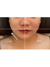 アリュール(Allure)/フェイシャル引き上げ