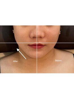 アリュール(Allure)/フェイシャル引き上げ