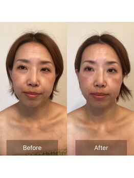 アイビー 二子玉川店(IB)/目元の悩み、クマの悩みにも！