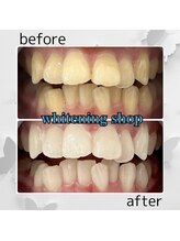 ホワイトニングショップ 太田店/ホワイトニングビフォアフター