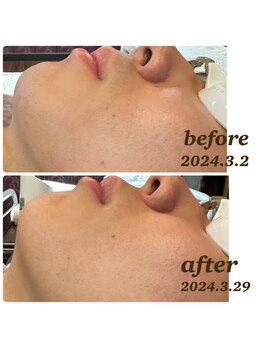 アンレーヴ/顔ひげ脱毛