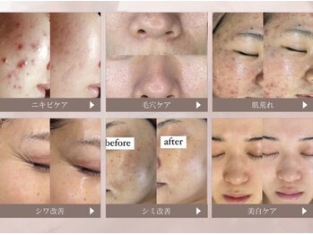 ホワイトアクア つくば店(WHITE AQUA)/圧倒的な美肌効果