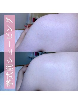 リンド エステ まつげ 京成大久保(Lind)/挙式前シェービング