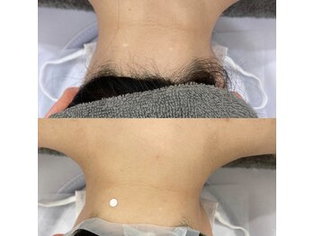 サロン アンド ビューティーエス(Salon&Beauty S)/うなじ脱毛☆