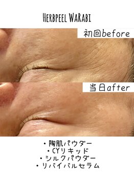 ハオン(HAON)/ハーブピーリング/ニキビ/毛穴