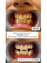 アレッド 大阪店(ared.)/２回でこの白さ！