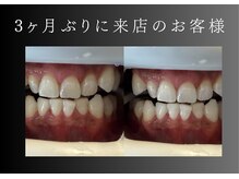 エランホワイトニング 一社店/症例写真　