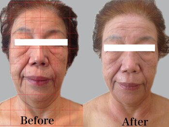 ジェイオー(J.O)/小顔矯正コルギ/リンパコルギ