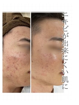 バーグトータルビューティー(bague total beauty)/繰り返しできてしまうニキビにも