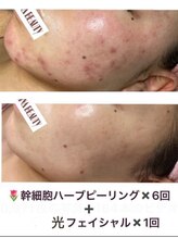 ジナ ビューティ(GINA BEAUTY)/幹細胞入りハーブピリング