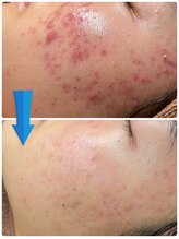 ラニ(Lani)/最新ハーブピーリングで肌質改善