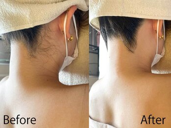 ライトウェーブ 松本村井本店/えり足脱毛 ビフォーアフター