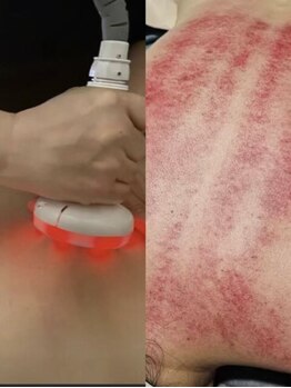 フェニックスの写真/★驚愕の効果実感★ 筋膜リリース※スリムムーブ