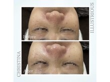 シャルムパリス(charme paris)/くすみ一層♪１回の施術変化