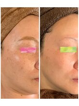 セラ(SERA)/ハーブピーリングケア