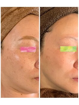 セラ(SERA)/ハーブピーリングケア