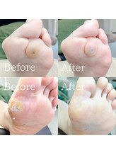 あしから/角質、魚の目ケア