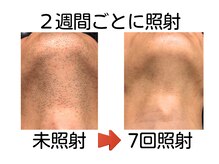 エビアス 旭川豊岡(evias)/メンズ店　大人気！ヒゲ脱毛♪