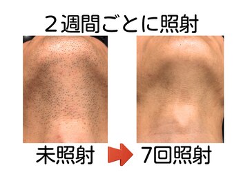 エビアス 旭川豊岡(evias)/メンズ店　大人気！ヒゲ脱毛♪