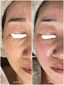 アミィ(amii)/肌育ボンバーフェイシャル