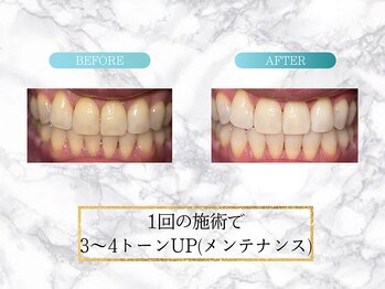 ロイヤル(ROYAL)/【ホワイトニング】before/after