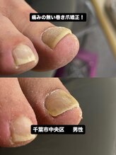 巻き爪じゅん 千葉駅前店/巻き爪の痛みに悩む方へ