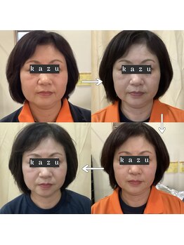 トータルヘルスビューティーカズ(TotalHealthBeauty KAZU)/【肌質改善】光の森/光美容