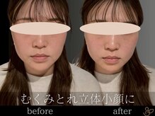 チョコバリ 恵比寿店(chocobari)/小顔リフトアップ（美容鍼）20代