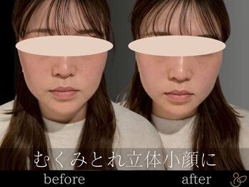 チョコバリ 恵比寿店(chocobari)/小顔リフトアップ（美容鍼）20代