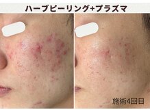ウェルビー(Well-Be)/ハーブピーリング＋プラズマ