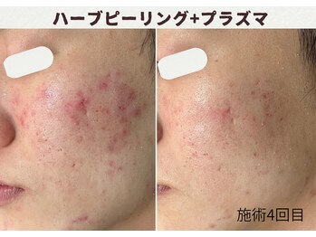 ウェルビー(Well-Be)/ハーブピーリング＋プラズマ