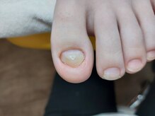 爪切り屋 足楽/肥厚爪はだか育成【before】