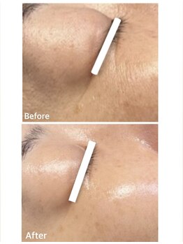 ピーロ(PiiiLO)/施術例/ソフト4回+ディープ6回