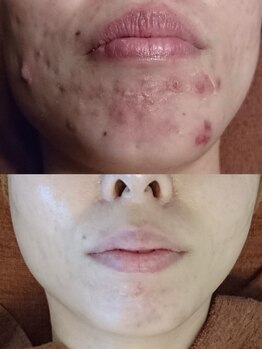 ソリッジ肌管理室/ニキビケア