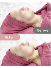 ミネット(minette)/レモンボトル＊before→after