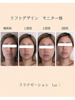 レイ(Lei)/リフトデザイン小顔　