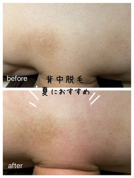 ルテラ(Lutella)/背中ワックス