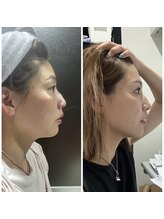 ディーロータス(D-lotus)/小顔