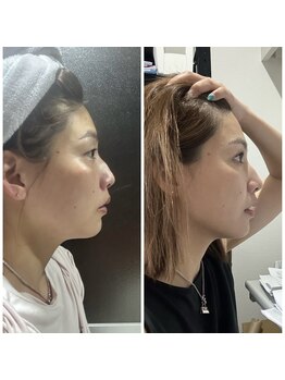 ディーロータス(D-lotus)/小顔