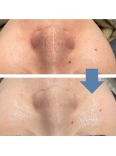 レベンディス(LEVENDIS)/毛穴洗浄ハイドロ&ララピール