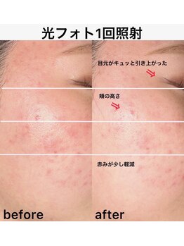 イエナ(IENA)/リフトアップ/小顔/肌荒れ/赤み