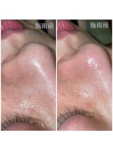 クレアーレ(creare)/どんな毛穴の黒ずみも一掃！！！